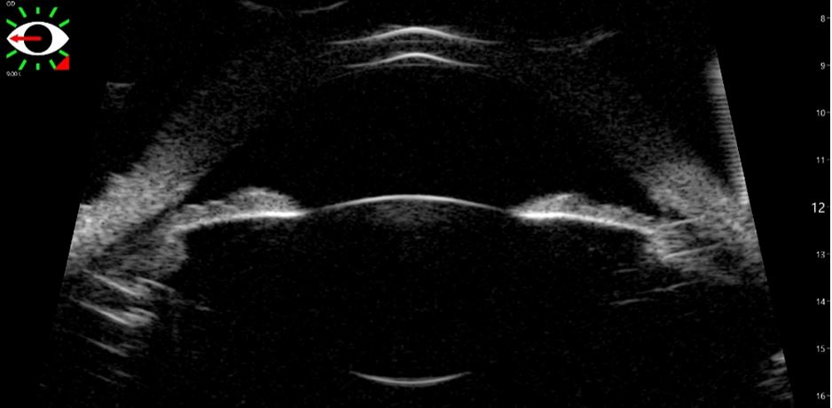 ultrasound advanced ophthalmologic diagnostic device