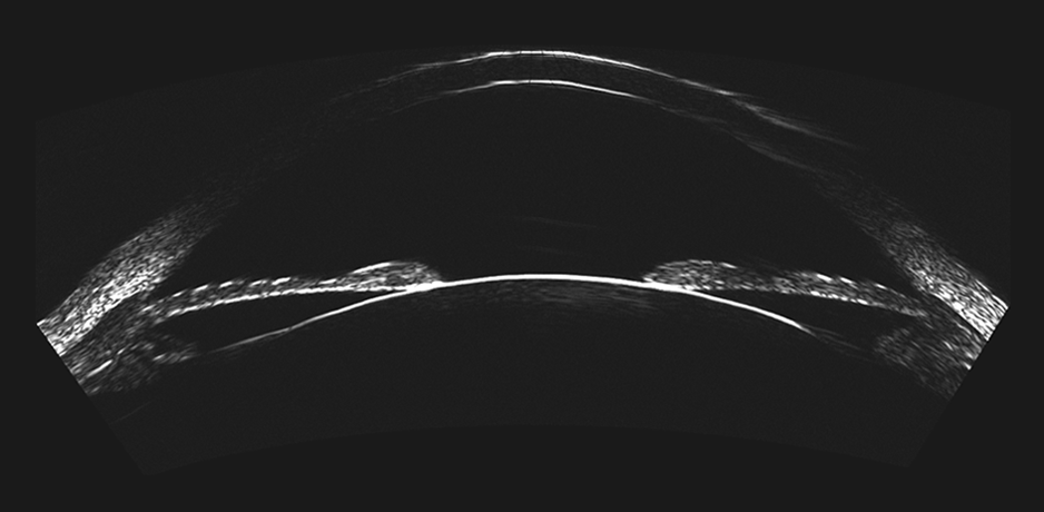 ultrasound advanced ophthalmologic diagnostic device